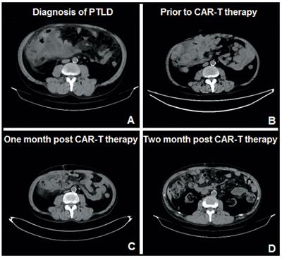 Safety and Efficacy of Anti-CD19-Chimeric Antigen Receptor T Cell Combined With Programmed Cell Death 1 Inhibitor Therapy in a Patient With Refractory Post-Transplant Lymphoproliferative Disease: Case Report and Literature Review